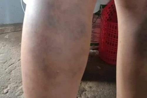 Quảng Nam: Kỷ luật cảnh cáo giáo viên chủ nhiệm đánh học sinh bầm tím 2 chân