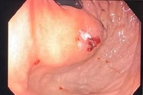 Cứu người đàn ông bị vỡ tĩnh mạch dạ dày nguy kịch