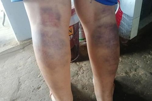 Cô giáo đánh nam sinh bầm tím 2 chân bị kỷ luật cảnh cáo