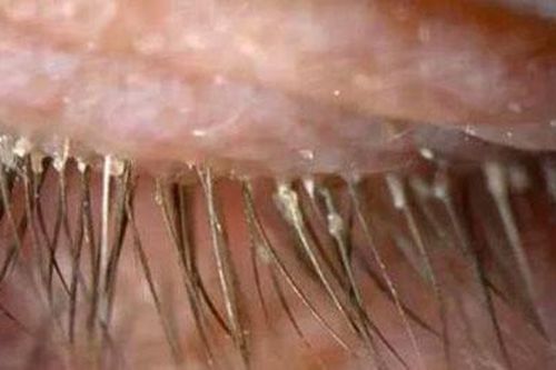 Rùng mình phát hiện rận xâu thành chuỗi bám chặt mi mắt người phụ nữ