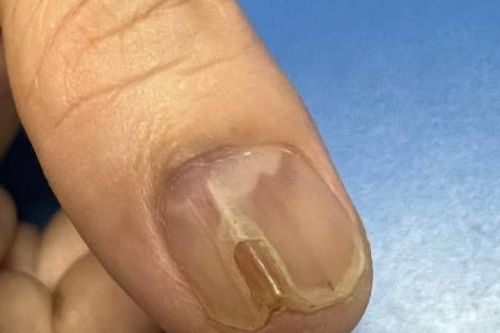 Đau âm ỉ suốt 7 năm trời, đi khám phát hiện khối u dưới móng tay