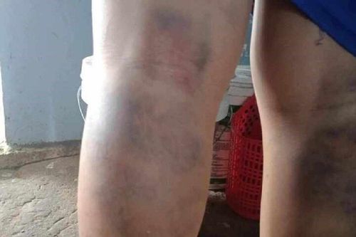 Kỷ luật cảnh cáo cô giáo đánh bầm tím 2 chân học sinh lớp 6