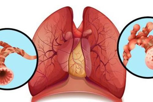 6 câu hỏi thường gặp về bệnh giãn phế quản