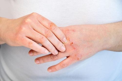 Khắc phục da tay khô trong mùa đông