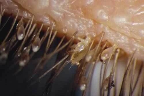 Rận bám đầy trên mi mắt người phụ nữ