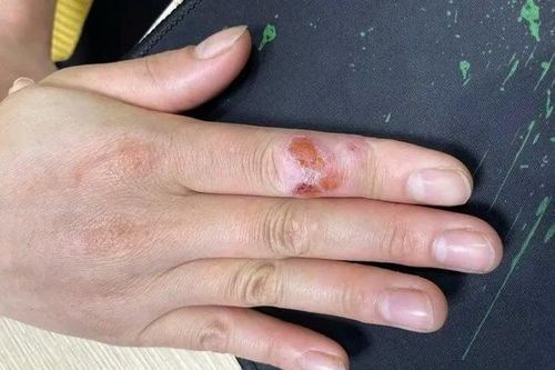 Mắc u hạt do... thú vui nuôi cá cảnh không đúng cách