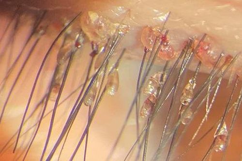 Người phụ nữ 46 tuổi bị rận bám chi chít ở mi mắt, cảnh báo thói quen trong sinh hoạt nhiều người hay gặp phải
