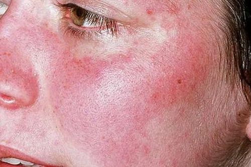 Lưu ý tập luyện cho người bệnh lupus ban đỏ
