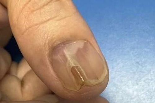 Đau sưng ngón tay suốt 7 năm, đi khám phát hiện u hiếm gặp