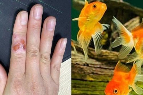 Mắc bệnh hiếm gặp sau nhiều năm chăm cá cảnh