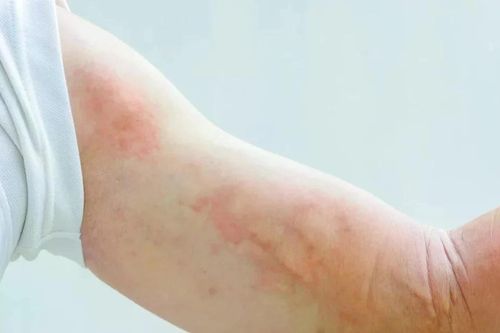 Triệu chứng và cách phòng ngừa mày đay mùa lạnh