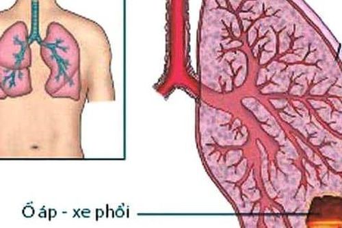 Áp xe phổi ai dễ mắc?