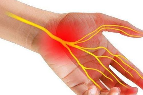 Tê tay cảnh giác với hội chứng ống cổ tay