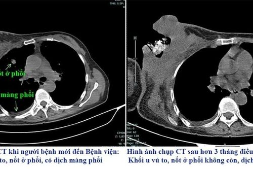 Bị vỡ, loét khối u vì đắp thuốc nam điều trị