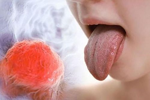 Phải cắt bỏ lưỡi vì vết loét nhỏ, chuyên gia cảnh báo