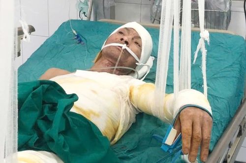 Ngã vào bãi rác đang cháy, người đàn ông bị bỏng nặng cần giúp đỡ