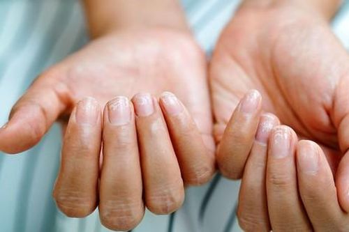 Móng tay giòn có phải do thiếu vitamin, khoáng chất?