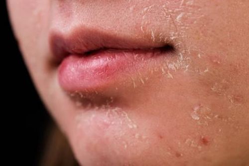 Cách chăm sóc da khô, hay bị nứt nẻ vào mùa lạnh