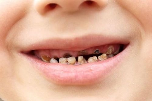 Trẻ sâu răng cẩn thận biến chứng viêm tủy răng gây nguy hiểm