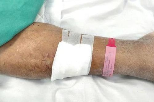Chủ quan với vết xước trên da, người đàn ông nguy kịch