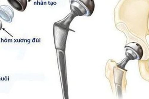 Các phương pháp điều trị hoại tử chỏm xương đùi