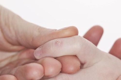 Mụn cóc ở tay chữa thế nào?