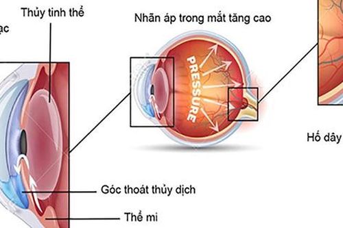 6 bước ngăn ngừa tăng nhãn áp gây hại thêm cho thị lực