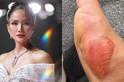 Chân sưng phồng, H'Hen Niê nén cơn đau diễn catwalk tự tin