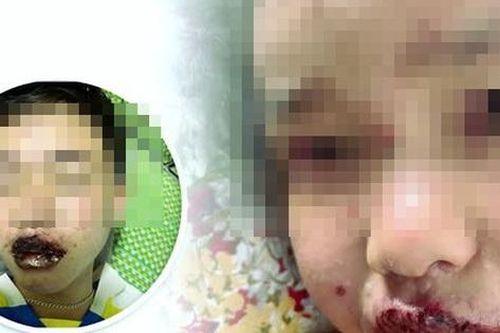 Trẻ bị tổn thương da nặng do dị ứng chậm