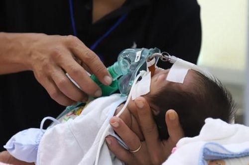 Điều trị thành công cho bé trai bị vòng mạch quấn chèn khí phế quản