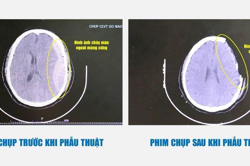 Chảy máu não sau cú ngã thang 3 mét, người đàn ông thoát hiểm nhờ phương pháp hạ thân nhiệt chỉ huy
