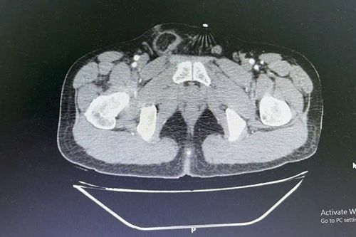 Bị thoát vị bẹn, người bệnh 49 tuổi được phẫu thuật nội soi đặt lưới