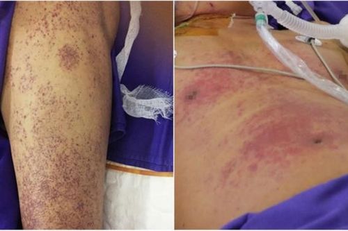 Một thợ xây mắc bệnh lý nguy hiểm do nhiễm liên cầu lợn