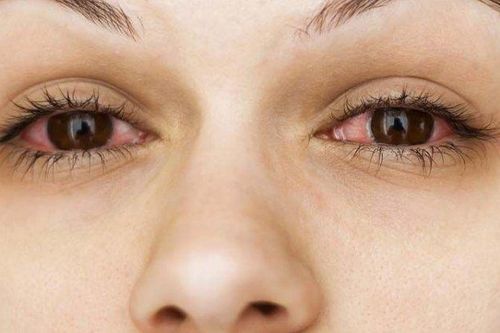 5 cách bảo vệ mắt vào mùa đông