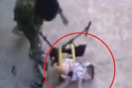 Ngã xe đẩy bé 13 tháng tuổi bị gãy xương hàm mặt