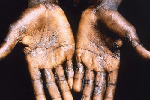 Những phát hiện về bệnh lạ ở Congo