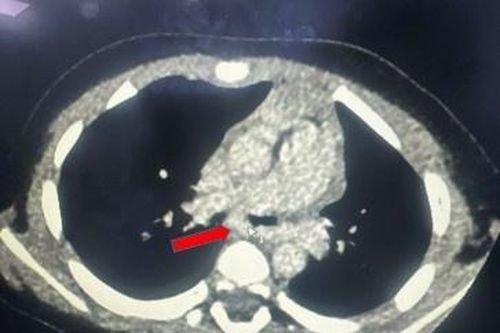 Bố mẹ bất ngờ khi biết lý do khiến con trai khò khè suốt 3 tháng