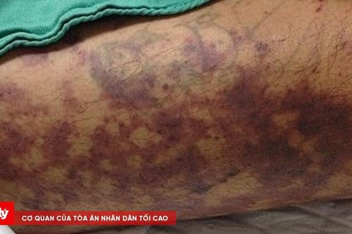 Người đàn ông ở Huế nhiễm liên cầu lợn sau khi ăn cơm thịt luộc ở quán