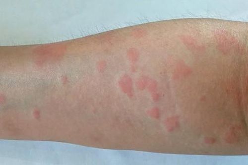 Thuốc điều trị lupus ban đỏ