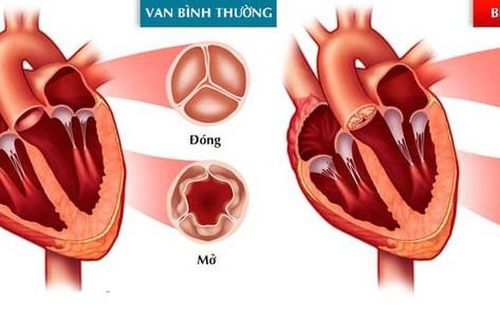 Nhận biết và phòng bệnh van hai lá