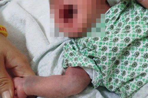 Ca sốt xuất huyết lây truyền từ mẹ sang con hiếm gặp