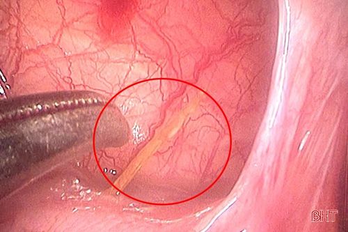 Gắp thành công xương cá dài 3 cm đâm thủng đường tiêu hóa