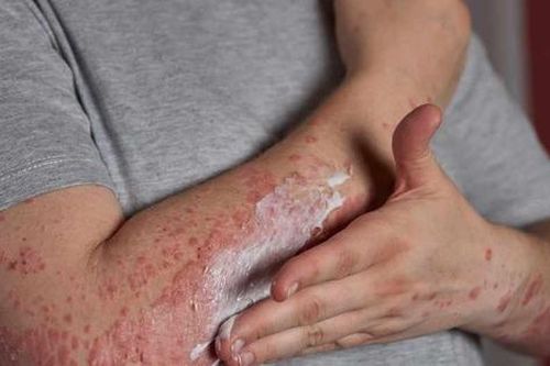 Ai có nguy cơ mắc viêm da dị ứng?