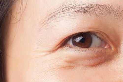 Nguyên nhân gây bọng mắt và cách khắc phục