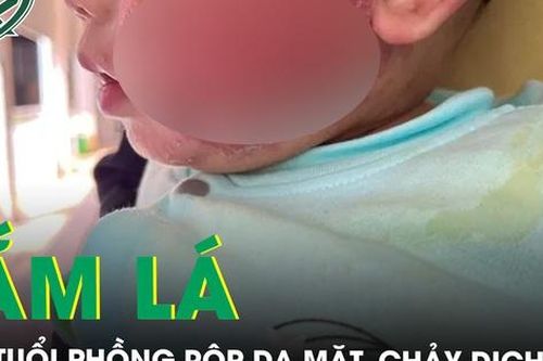 Xót xa bé trai 1 tuổi phồng rộp cả mặt, chảy dịch vì tắm lá chữa viêm da cơ địa