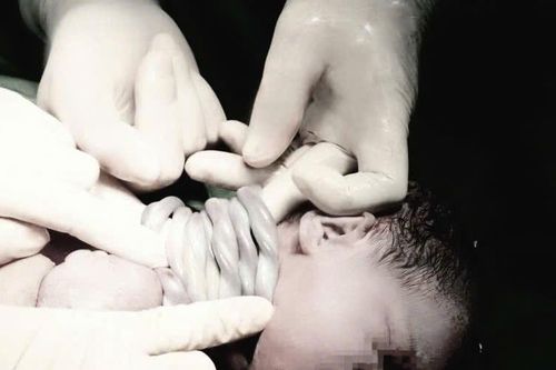Cực hiếm: Bé gái 'vượt ngàn chông gai' chào đời với 9 vòng dây rốn quấn cổ