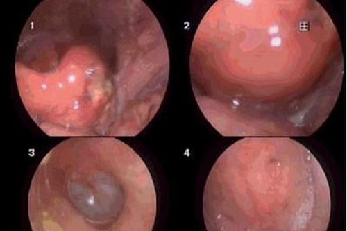 Bị phù nề hạ họng, thanh quản vì cố tự xử lý hóc xương cá