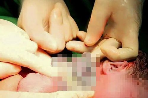 Em bé 'vượt thử thách' 9 vòng dây rốn quấn cổ chào đời khỏe mạnh