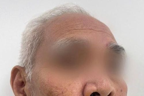Người đàn ông bị chó cắn đứt rời môi dưới
