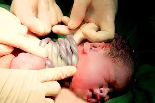 Kỳ diệu: Bé gái chào đời khỏe mạnh với 9 vòng dây rốn quấn cổ